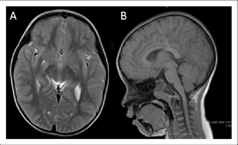 A Axial T2 Weighted And B Sagittal T1 Weighted Brain Magnetic