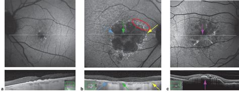 Age Related Macular Degeneration American Academy Of Ophthalmology