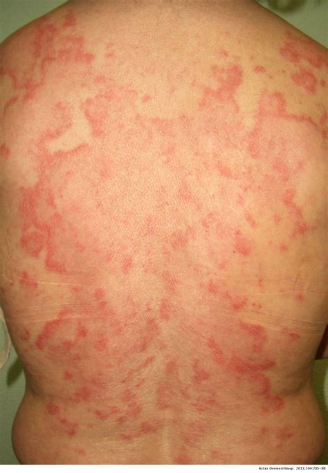 Carcinoid Syndrome Rash