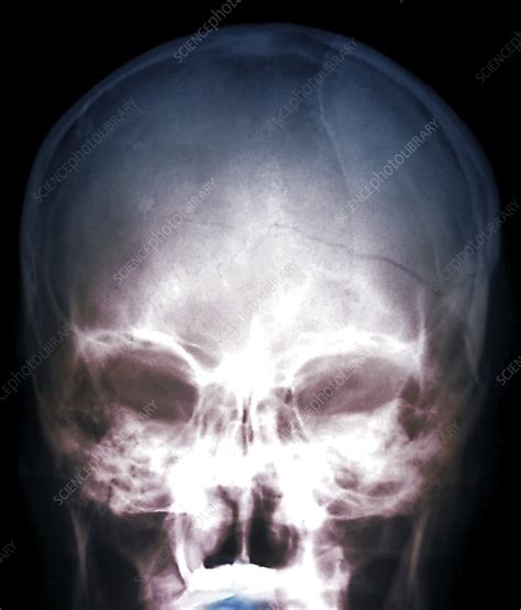 Skull fracture, X-ray - Stock Image - C040/3079 - Science Photo Library