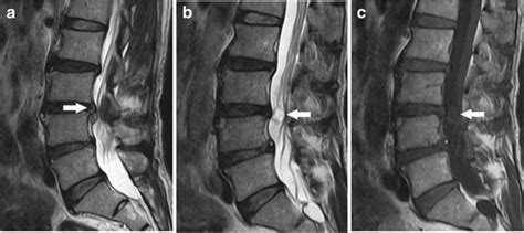 Multiple Cauda Equina Schwannomas In Neurofibromatosis Type Pacs