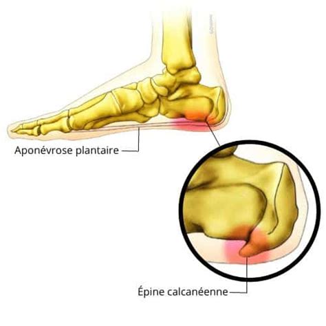 Épine calcanéenne définition et causes de la pathologie