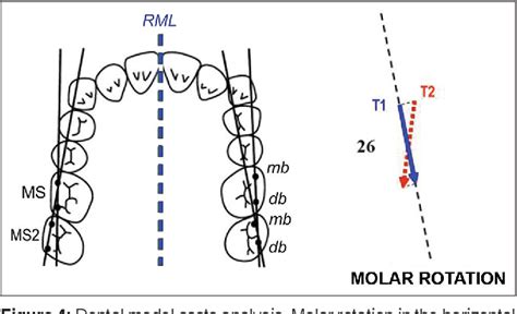 Figure From Maxillary Molar Distalization With Mgbm System In Class