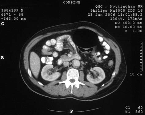 Abdominal Computed Tomography Demonstrating A Large Gas Filled