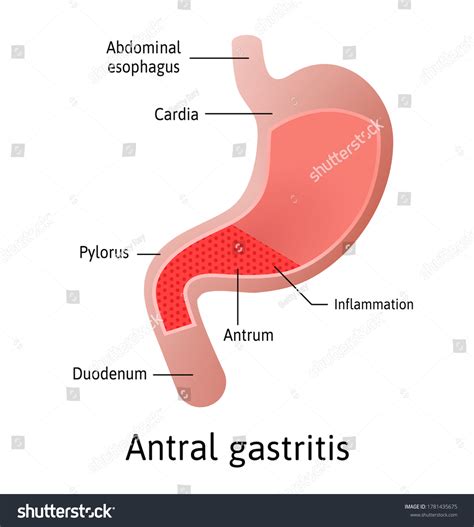 Antral Location Gastritis Inflammation Lining Stomach Stock Vector ...