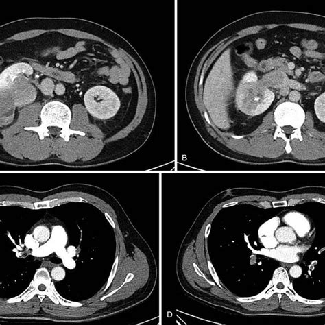 A Preoperative Abdominal Computed Tomography Scans Showing A Right