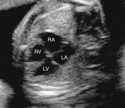 Persistent Truncus Arteriosus | Radiology Key