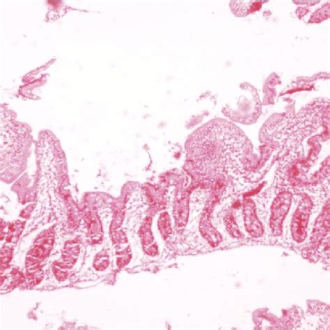 Duodenal Biopsy Showing Shortening And Flattening Of Villi H And E ×