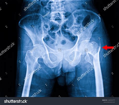 Hip Fracture Xray Photo Image X-ray Stock Photo 1446722777 | Shutterstock