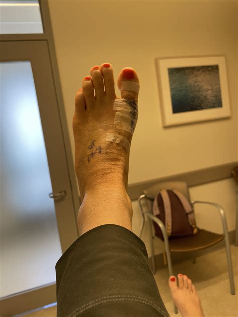 1st post-op visit 6/24 (6/13 Austin / chevron bunionectomy) : r/bunions