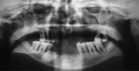 Orthopantomogram Showing A Well Defined Radiopacity In Relation To