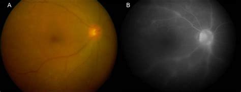 Primary Intraocular Central Nervous System Lymphoma Masquerading As Diffuse Retinal Vasculitis