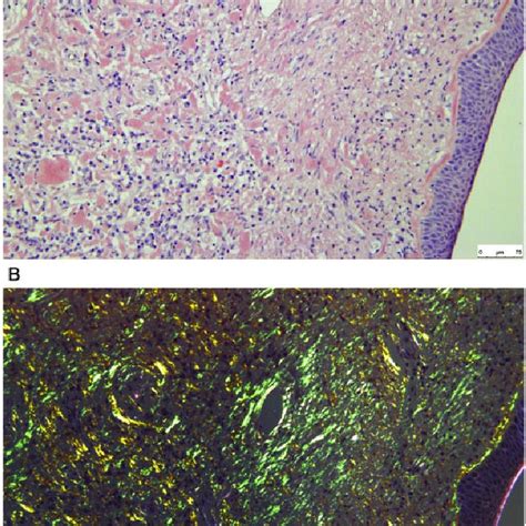 A Amyloid On Congo Red Showing Red Stain Of The Amorphous