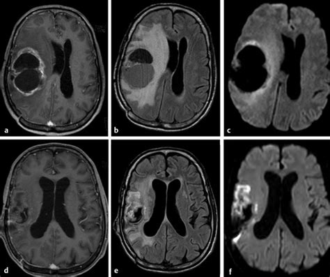 Diffusion Weighted Imaging In The Evaluation Of Brain Tumors