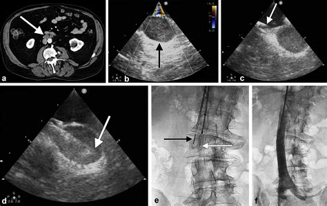 Intravascular Ultrasound Guided Transvenous Biopsy Of Abdominal And