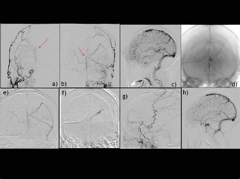 Figure 2 from Borden type3 superior sagittal sinus dural arteriovenous ...