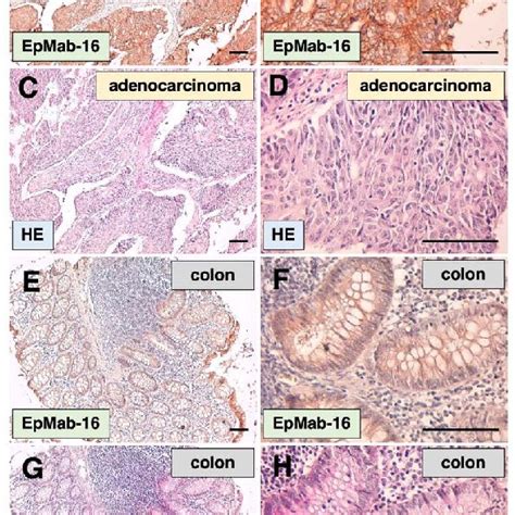 Immunohistochemical Analysis Of Colorectal Adenocarcinoma And Normal