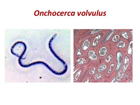 Filarial worms dr. rs 28 08-2017