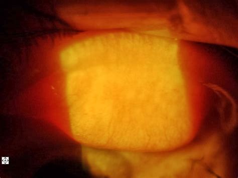 GIANT PAPILLARY CONJUNCTIVITIS (GPC) | Sonoran Desert Eye Center