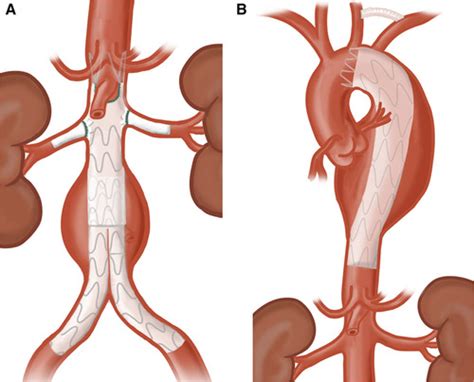 Open And Endovascular Management Of Aortic Aneurysms Circulation Research