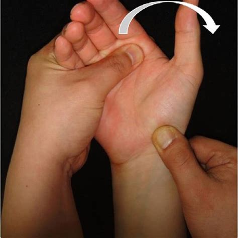 All Dorsal Scapholunate Reconstruction With Internal Brace Ligament