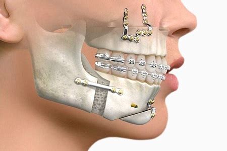 Cirugía Maxilofacial Ortognática Cirugía Especializada en Lima Perú