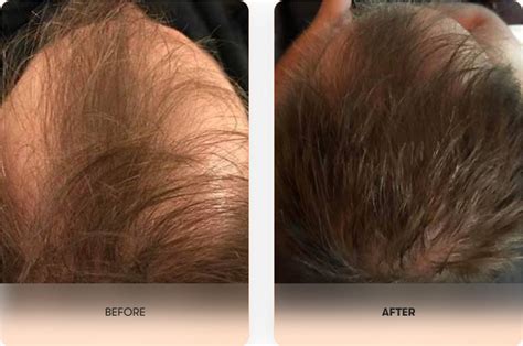 Hair And Scalp Treatment Dermaroller® Micro Needling Collagen