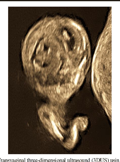 First Trimester Diagnosis Of Cervico Thoracic Diastematomyelia And