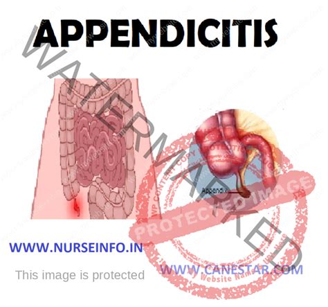 appendicitis nurse info