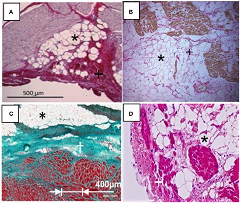 Frontiers Fatty Infiltration Of The Myocardium And Arrhythmogenesis