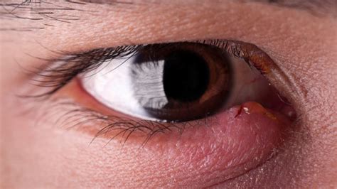 How to Get Rid of a Stye: 8 Home Remedies and Treatments