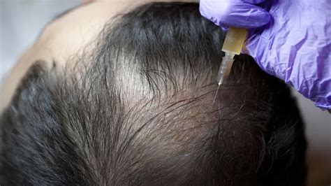 Benefits of Prp Injections for Hair Loss Treatment - Trendingbird