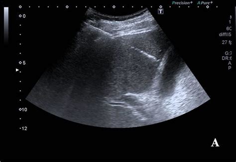 Ultrasound Guided Transhepatic Percutaneous Cholecystostomy Images A