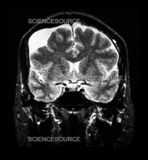 Photograph Mri Of Arachnoid Cyst Science Source Images