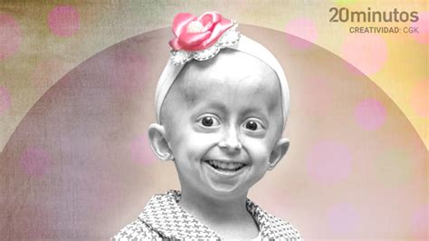 Descubren Una Nueva Diana Para Tratar La Progeria La Enfermedad Del