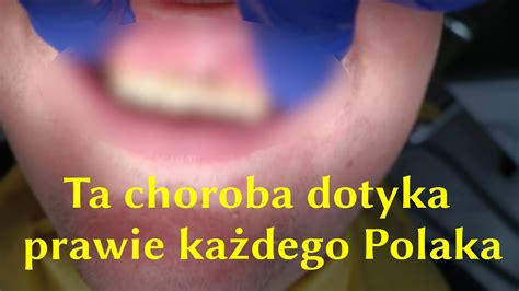 Próchnica wszystko co powinien wiedzieć pacjent YouTube