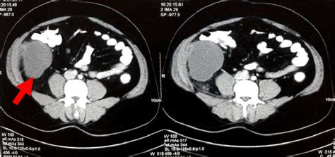 Cect Abdomen Showing Retroperitoneal Cystic Lesion Arrow Download