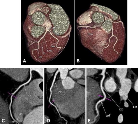 A And B Colored 3d Vrt Image Ce Curved Mpr Images Showing Normal