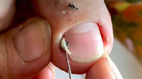 How To Cut Thick Toenails Toenail Cleaning Satisfying Youtube