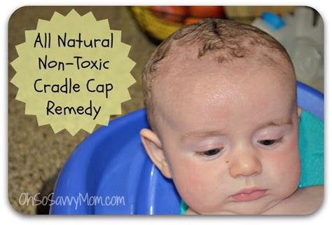 All Natural Non Toxic Cradle Cap Remedy Baby Cradle Cap Cradle Cap