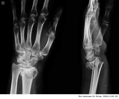 Tratamientos Para La Fractura De Radio Distal Top Doctors