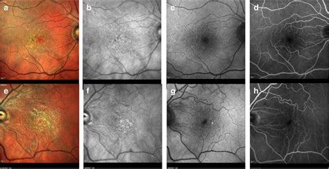 The Panel Shows Baseline Multimodal Imaging Characteristics Of A