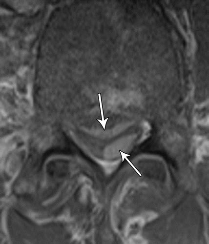 Spinal Hematomas What A Radiologist Needs To Know Radiographics