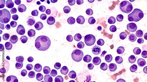 Multiple Myeloma Awareness Bone Marrow Aspirate Cytology Of Multiple