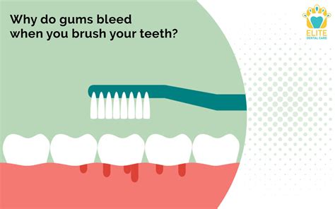 WHY DO GUMS BLEED WHEN YOU BRUSH YOUR TEETH ELITE DENTAL CARE TRACY