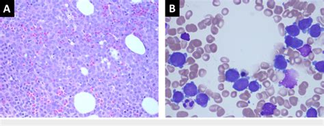 H E Stain Of Bone Marrow Core Biopsy A And Wright Giemsa Stain Bone