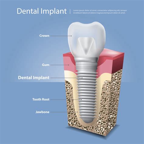 The Anatomy Of The Dental Implant Knoxville Tn Dentist