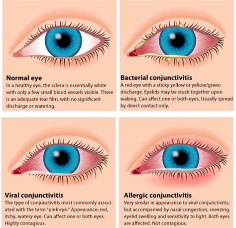 Allergic Conjunctivitis Stringy Discharge