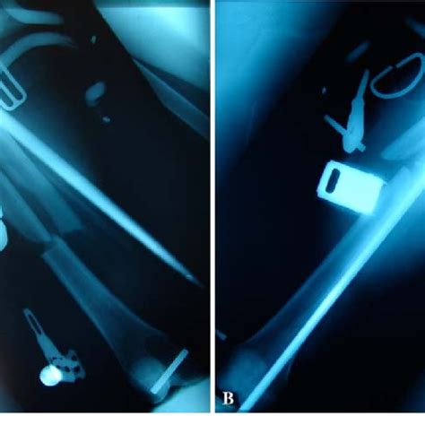 A B Preoperative Anteroposterior Radiographs Of The A Right And B Download Scientific