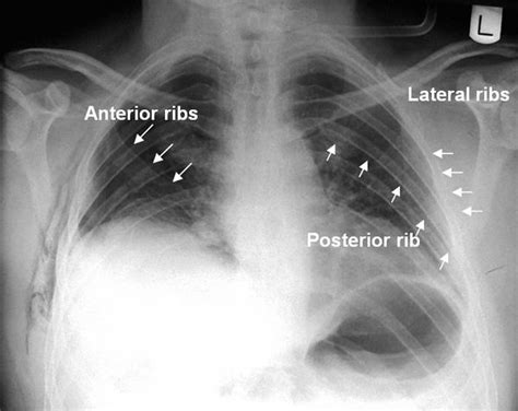 Imaging Rib Fractures Rib Fracture Radiography Ribs